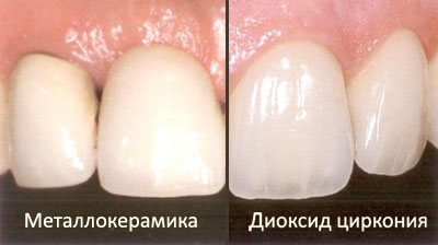 Минусы металлокерамики, которых нет у керамики