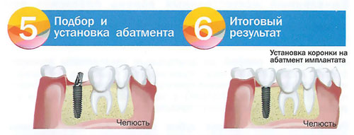 Этапы установки зубного абатмента - стоматологическая клиника СитиДентаМед в Жодино