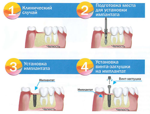 Этапы установки зубного имплантанта - стоматологическая клиника СитиДентаМед в Жодино