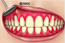 Флюс. Cтоматологическая клиника СитиДентаМед в Жодино
