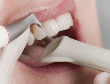 Профессиональная гигиена. Cтоматологическая клиника СитиДентаМед в Жодино