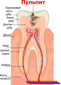Пульпит. Cтоматологическая клиника СитиДентаМед в Жодино