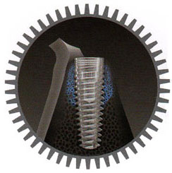 Зона механической стабильности имплантата MIS - стоматологическая клиника СитиДентаМед